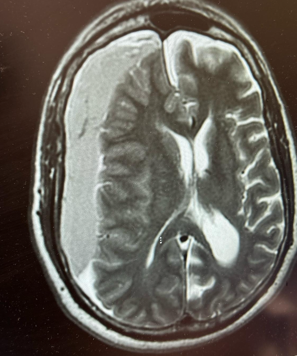 Strokes and Management